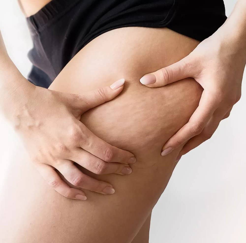 ragazza inestetismi cellulite
